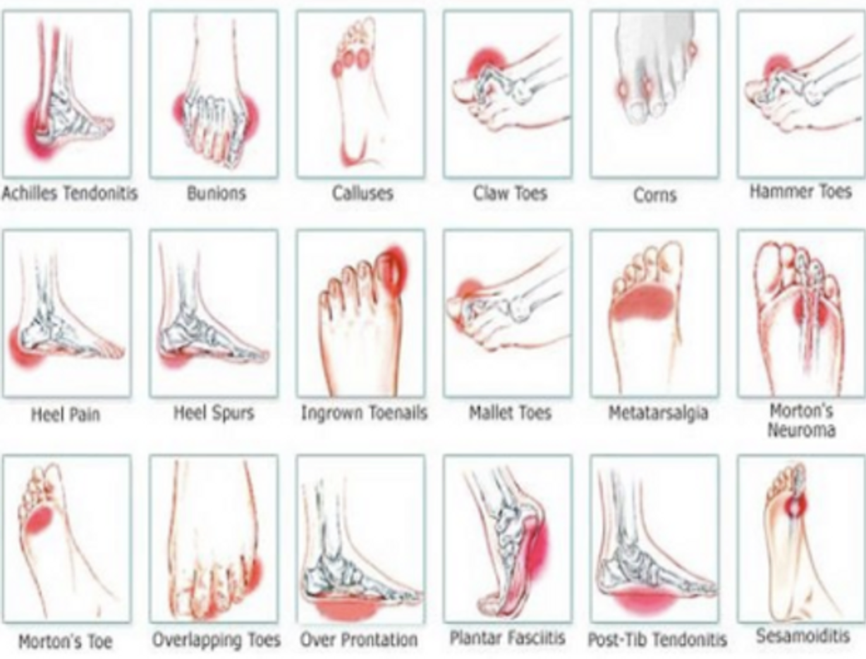 Common Causes of Foot & Ankle Pain - Surrey Orthopaedic Clinic