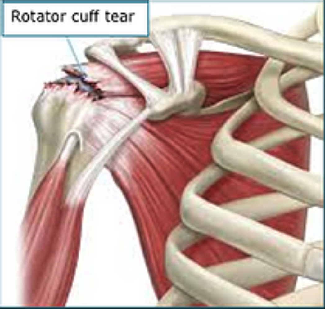 Rotator Cuff Tear of the Shoulder Surrey Orthopaedic Clinic