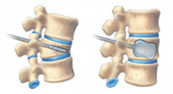 Spine Fractures - Surrey Orthopaedic Clinic