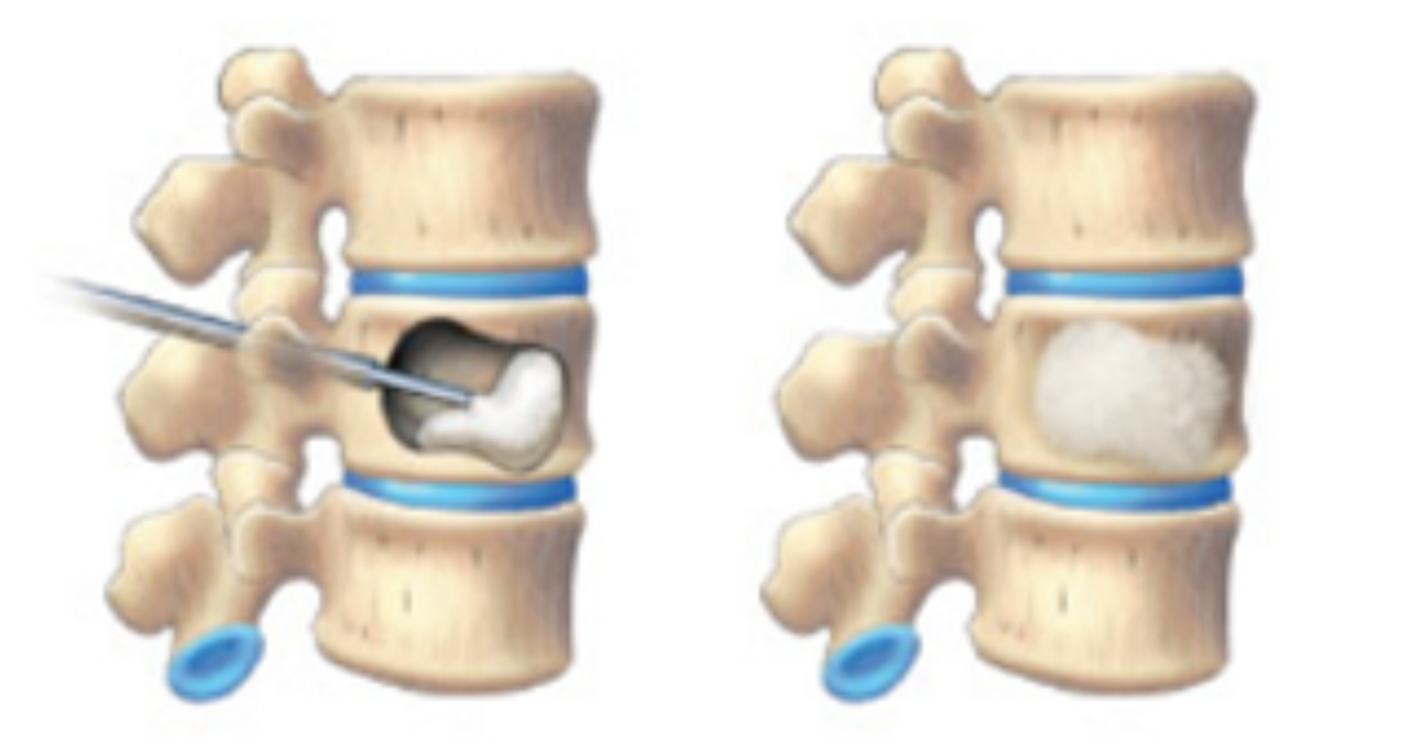 Spine Fractures - Surrey Orthopaedic Clinic