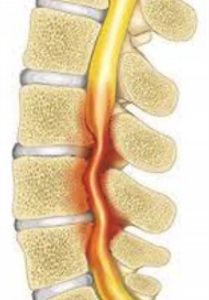 Spinal Stenosis - Surrey Orthopaedic Clinic