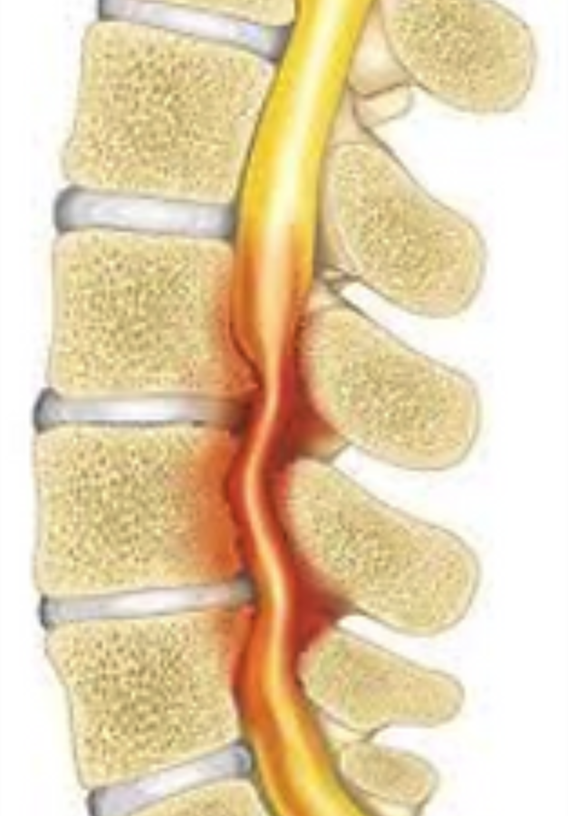 Spinal Stenosis - Surrey Orthopaedic Clinic