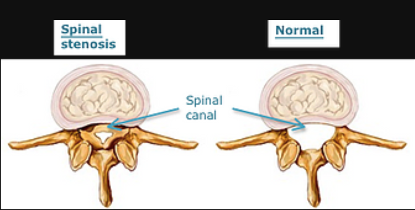 Spinal Stenosis - Surrey Orthopaedic Clinic