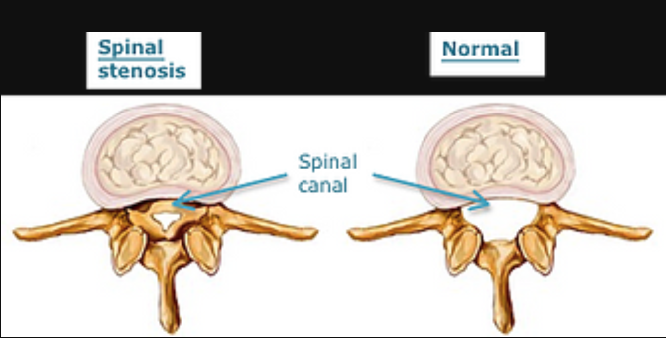 Spinal Stenosis