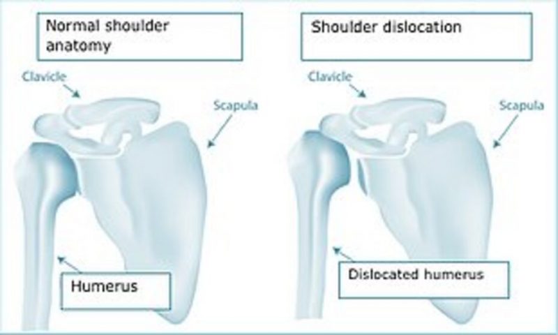 Shoulder Dislocation & Instability - Surrey Orthopaedic Clinic