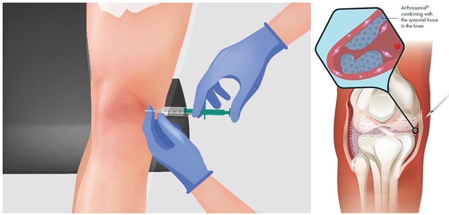 Arthrosamid injections diagram